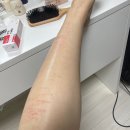 풀독 | 골프장 라운딩 갔다가 풀독 올라서 접촉성피부염 치료받은 후기