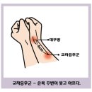 교차증후군(intersection syndrome)을 아시나요? 이미지