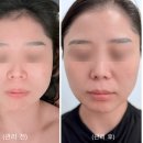 반도유보라1차 521동 맞은편 | 대구 에스테틱 추천 V에스테틱 맞춤 윤곽리프팅 내돈내산급 1회차 솔직후기