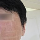 오아로피부과의원 청량리 | 청량리 피부과 여드름 흉터 울트라클리어 통증, 효과 2주차 후기