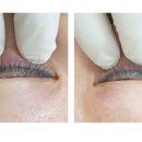 수아이의원 | ✨ 강남 아이라인 제거, 브라운아이 의원 솔직 후기 ✨