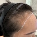 여자 헤어라인 이식 비절개 6곳 상담 후기