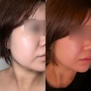 아름다운차이 - 남구 문수로435번길 17 | 강남피부과 미글로우리프팅 온다리프팅 차이 비교 60kj 후기