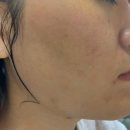 재생한의원 | 여드름한의원 피부 심부재생치료 가격 내돈내산 후기