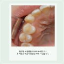 어울림치과기공소 네이버블로그