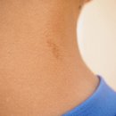 아이 몸에 커피색 반점이… '신경섬유종' 초기 신호일 수도 이미지