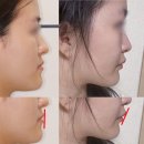 바른턱얼굴미치과의원 | 성인주걱턱교정, 턱교정기 1년 쓰면 이렇게 됩니다
