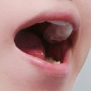 디메디 | 자다가 턱에서 소리나는 이유 (디메디 이갈이마우스피스 사용법)