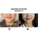 함께웃는한의원 | 얼굴비대칭 한의원 매선침 내돈내산 찐후기, 입꼬리비대칭 입술비대칭