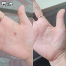 부평 휴의원 내돈내산으로 손바닥 사마귀 깔끔하게 제거한 후기