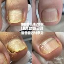 웃는세상의원 | [내성발톱 2회교정] 365이화웃는세상의원 내성발톱교정후기 구파발 강서구 구파발역 연신내 불광동...
