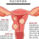 자궁 근종(물혹) 및 원인과 검사 예방 : 크기 통증 폐경기 임신 이미지