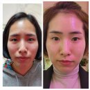 인셀덤카라 | 인셀덤 후기 : 이마라인을집중해서보세요