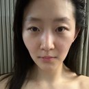 클래시성형외과 | 에스테틱 라뽀르 청담에서 안면 유지인대 비수술안면거상술 수기 윤곽관리 받은 솔직후기 - 작은얼굴 웨딩