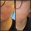 (주)피코차이나 | 용산프락셀 남자 여름철 피부관리 여드름 모공흉터 피코프락셀 1회차 솔직후기/효과/가격/통증