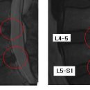 머든열심이님의 L4-5, L5-S1 요추 디스크 MRI 판독입니다. 이미지