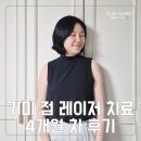 레이저 치료 #2 ♡ 기미·점 레이저 4개월 차 후기, 재시술 할까?