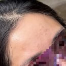 본그린약국 | 피부가 계속 뒤집어질 때 써본 브링그린 크림 내돈내산 후기