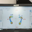 나도손톱 레푸스 개봉점 | 용산발각질 레푸스 용산역점 티눈 제거 후기