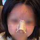 콧대높은 개 | ㅂㅌㅇ성형외과 코수술 후기 :: ㅎㄴ성형외과 쌍수 재수술 후기