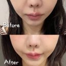 프라임 | [압구정로데오] 청담피부과 울쎄라프라임 내돈내산 후기