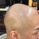 샵우리 | 결혼식 전 항암 탈모 신랑 찰리네 위그샵 부분가발 후기