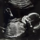 11650-16-142-10 | [임신20주차] 중기 정밀초음파 후기｜16주~20주차 증상, B형간염 2차 접종까지 💛