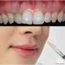 잇몸성형 보톡스 웃는 모습 개선 미용 시술 비수술