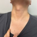 성지 | 대구쥐젖제거 한의원 편평사마귀무제한 성지 후기