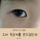 연수김안과의원 | 소아 덧눈꺼풀 수술 고민 중 안검내반 차이점 증상 체크리스트 연수김안과 진료 후기
