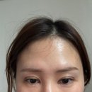 내돈내산 쌍꺼풀 재수술 한달 후기 2편 | 붓기 짝짝이 회복 과정