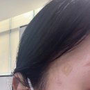 부천 선피부과성형외과 선의원 점빼기 2차 후기 | 점빼고 주의사항 | 수영은 두달 뒤..