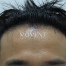 모수테라피