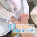 GS25 수성황금점 | 대구 수성구 무좀발톱 케어 전문 '르엘라 푸스케어' 비포애프터 후기