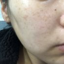 정영철피부과의원 | 얼굴 기미 잡티 제거 추천 목동역 정영철 피부과 의원추천