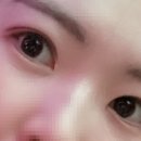 코코아이성형외과의원 | 지제이성형외과 부분절개 쌍꺼풀 수술 한달차 과정 후기❤️