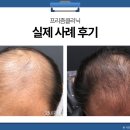 송정초등학교 | 강서구탈모치료 실제 사례│리제네라액티바 7개월차 경과 후기로 본 핵심 포인트