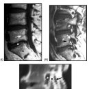 요추와 디스크, 연관조직의 퇴행성 변화를 관찰한 MRI 소견에 대하여 이미지
