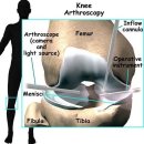 [십자인대 파열,십자인대수술]무릎연골파열,무릎연골 수술 이미지