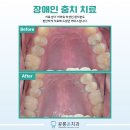 미소가득한 치과기공소 | 장애인치과 노원, 소통이 어려운 분도 괜찮습니다 - 장애인부모연대 소개 내원 후기