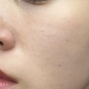 서현여드름 관리 재방문한 뮤르에스테틱 닥토필 솔직 후기