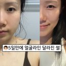 르네약국 | 르네핏 라인케어샷 붓기관리 이너뷰티 내돈내산 일주일 후기