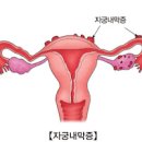 자궁내막증 증상 및 원인과 치료 관리 수술 : 임신 이미지