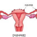 왼쪽 아랫배 통증 증상 원인 이미지