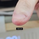 뷰티핀다 | 천안 넓은손톱교정 불당동 뷰티핀다에서 찾은 슬림한 라인
