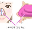 비갑개 성형술[turbinoplasty] 이미지