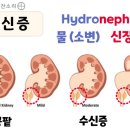 수신증[hydronephrosis] 이미지