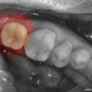 수진치과의원 | 부러져 뿌리만 남은 치아, 수진역치과 에서 디지털 임플란트 과정
