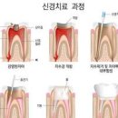 치과 신경 기간 및 시간 통증 비용 과정 : 치아 신경 후 통증 이미지