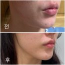 쿨 | [대치동피부과] 쿨소닉 리프팅 후기